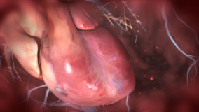 3d animated human heart with coronary blood vessels atrium ventricles beating rapidly showing abnormal irregular cardiac rhythm as seen in myocardial infarction heart attack or tachycardia